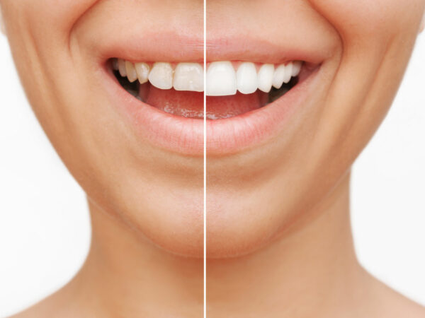 6 astuces pour vous blanchir les dents naturellement