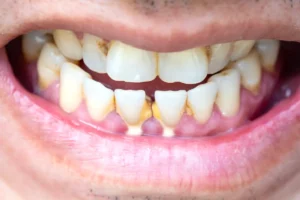 Mauvaise haleine et caries : comment éviter les effets néfastes du tartre dans votre bouche