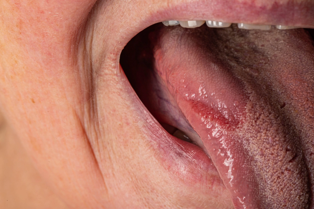 Les remèdes de grand-mère les plus efficaces pour soulager une brûlure à la langue