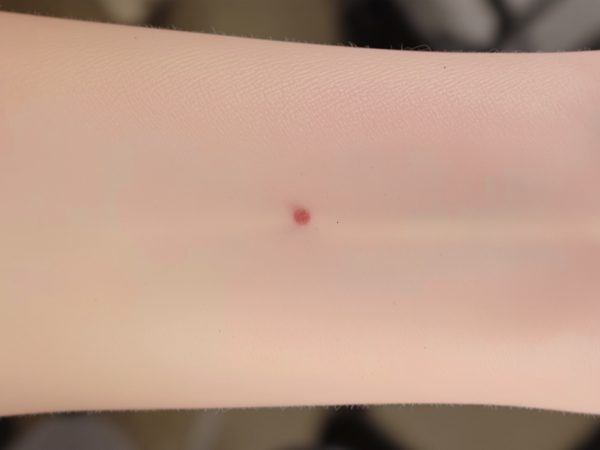 cicatrice_vaccinale_bras