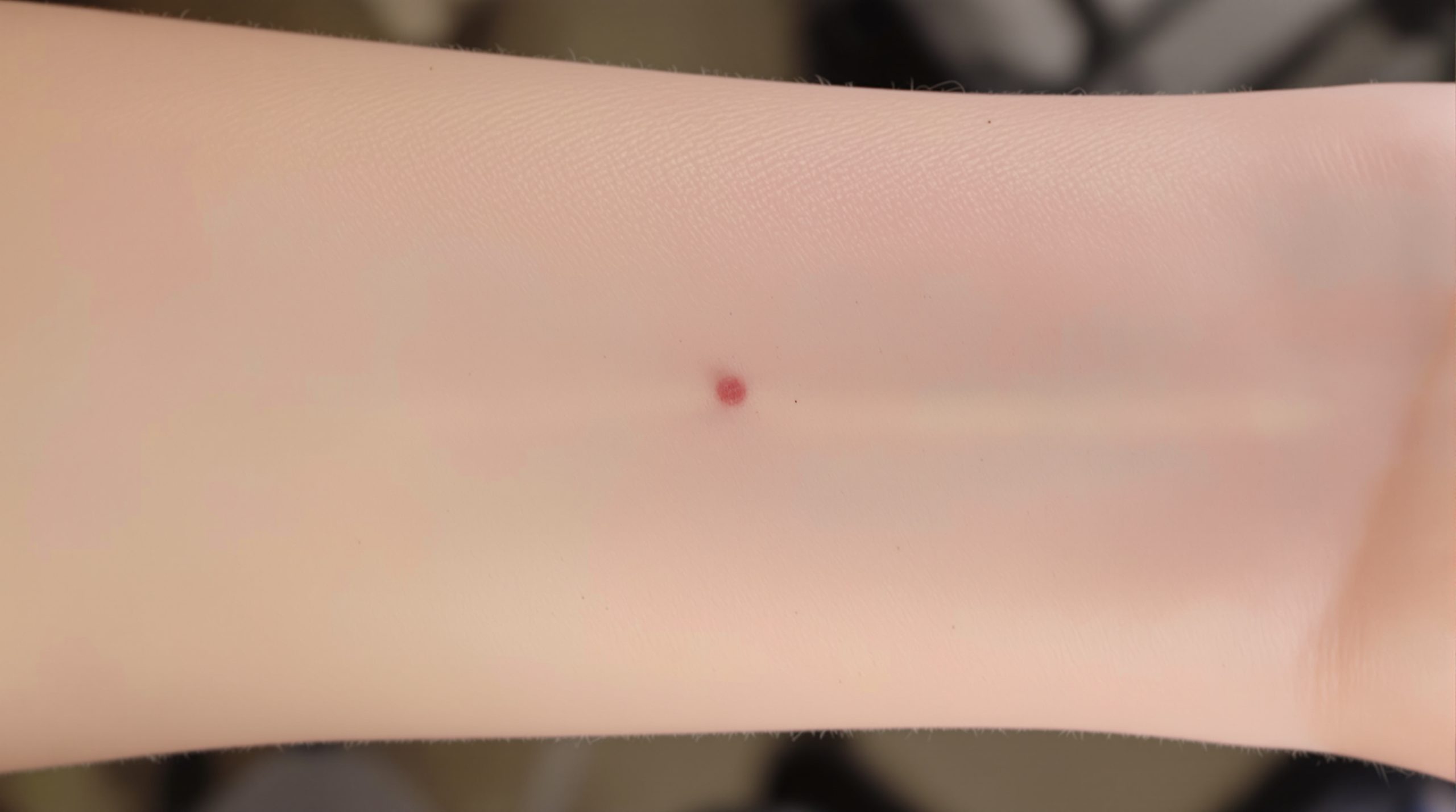 cicatrice_vaccinale_bras